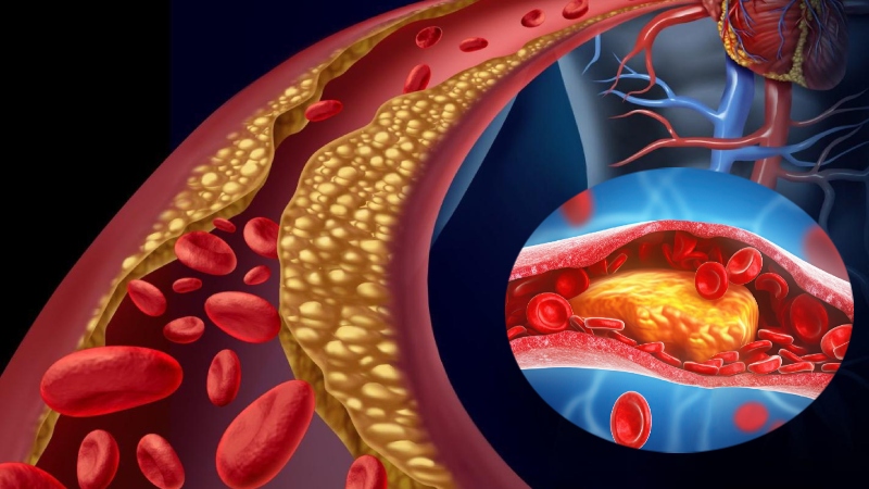 হৃদরোগের ঝুঁকি কমাতে কোলেস্টেরল নিয়ন্ত্রণের ৭ উপায়